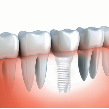 ceramic dental implants