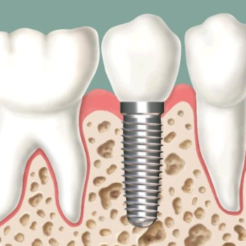 dental-implant-image