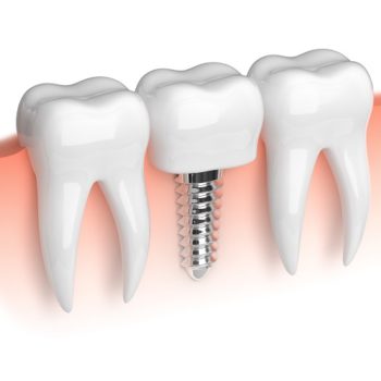Model of white teeth and dental implant