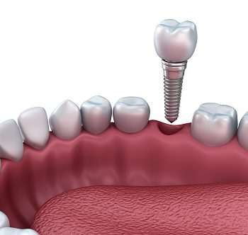 3d lower teeth and dental implant isolated on white